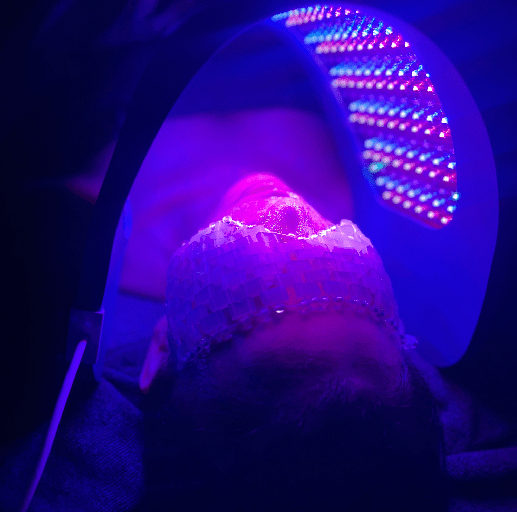 DERMAPLANING